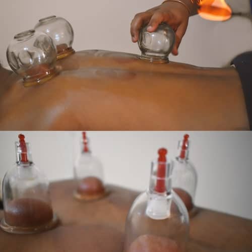 Cupping Therapy - Sri Raghavendra Ayurvedic Hospital Hyderabad Telangana